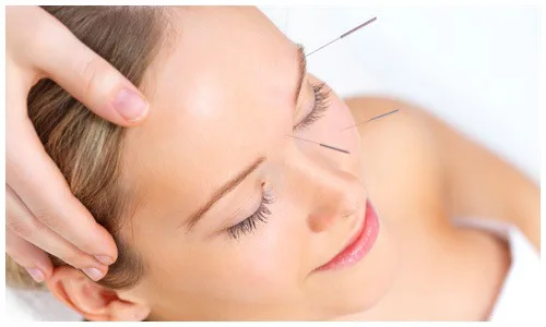 Aculifting and acupuncture